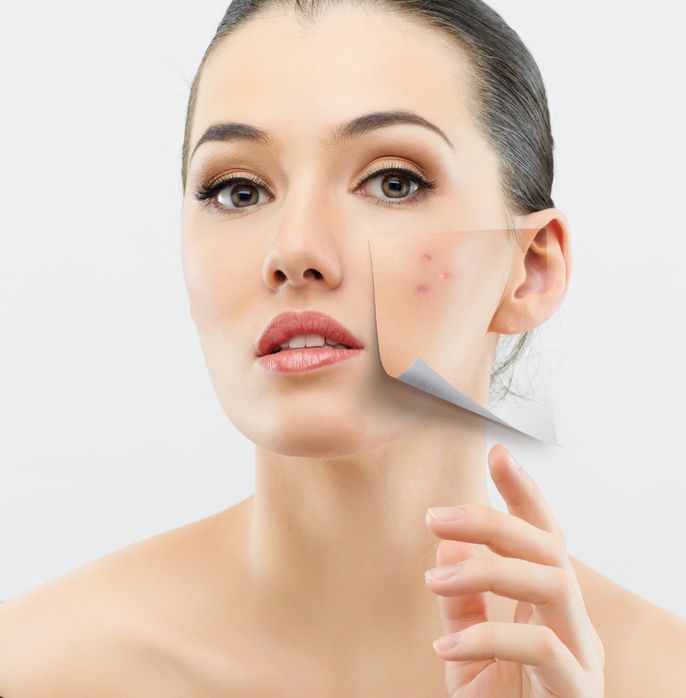 Acne Don’ts: The 7 Things You Should Never Do To Your skin When You Have Acne (And Even If You Don’t) 